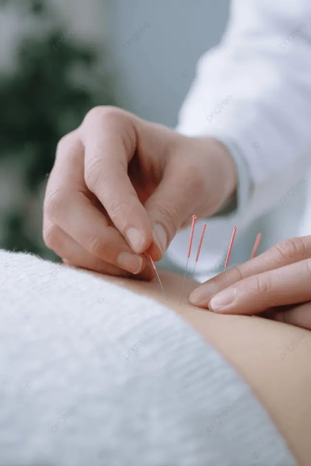 Acupuncture